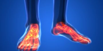 בעיות בהליכה בעיות בהליכה יכולות להיגרם משלל סיבות; פציעה ברגל או בעמוד השדרה, בעיות במפרקים, ניתוחים, דלקות שונות ועוד. אורן זריף