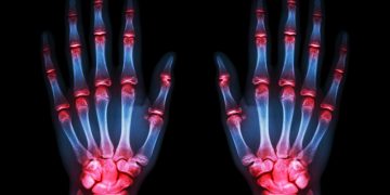 בעיות במפרק היד סיפור מרגש שכדאי לקרוא אורן זריף