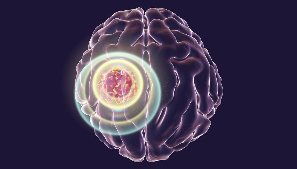 CVA And Stroke Prevention – Oren Zarif