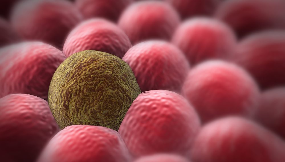 עובדות שלא ידעתם על מחלת הסרטן – אורן זריף