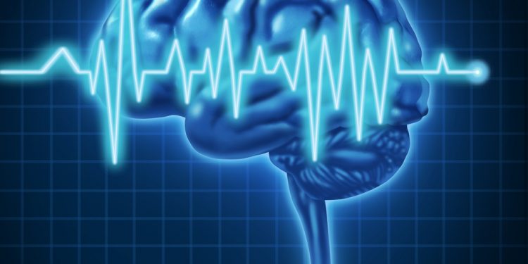 CVA And Stroke Prevention – Oren Zarif